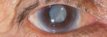 A photo of a human eye - catarct