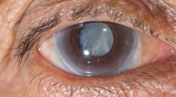 A photo of a human eye - catarct