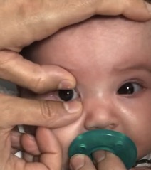 Removing a contact lens from a baby's eye