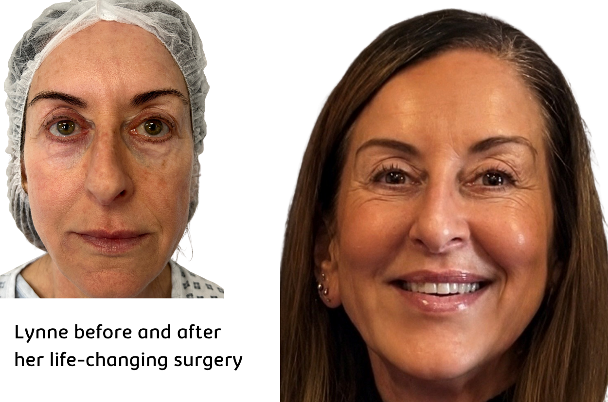 Lynne before and after her life changing surgery