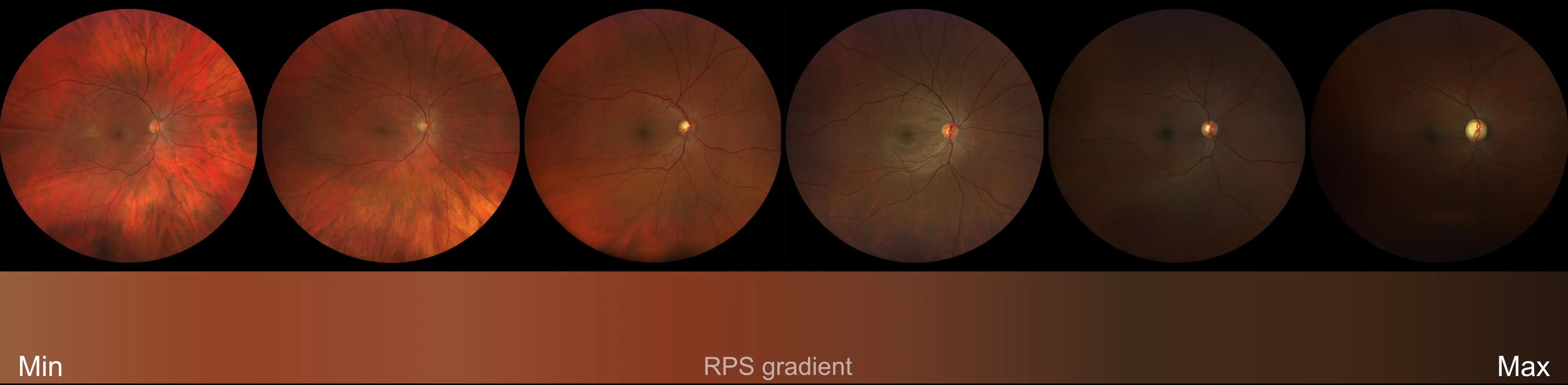 Scale Of Retinal Pigment Reflecting Variations Among Patients