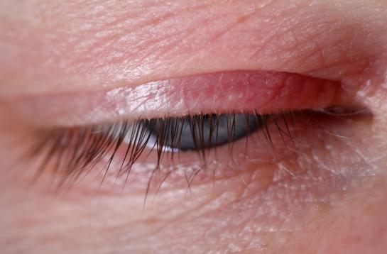 A photo of an inflamed eyelid