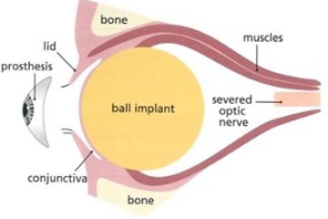 Implant in the Socket