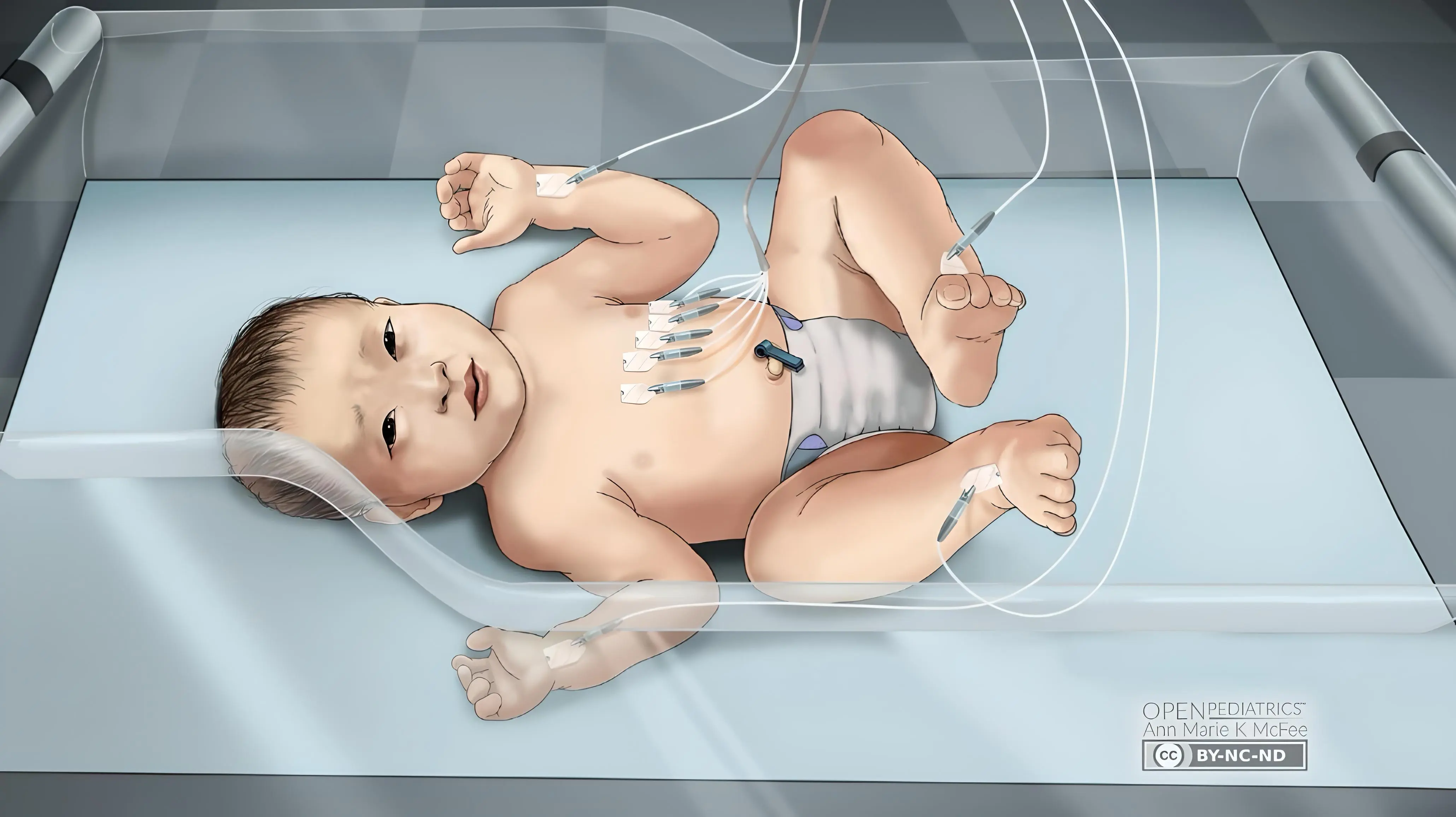 Example of ECG leads placement 