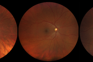 Scale Of Retinal Pigment Reflecting Variations Among Patients close-up 