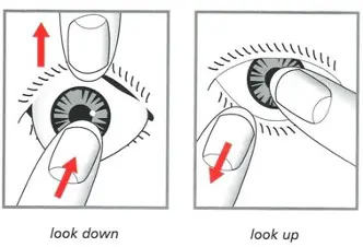 Diagram showing the fitting of a Prosthetic Eye