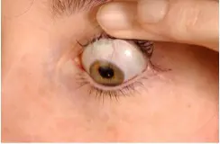 Fingertips pulling upper eyelids up with an eye looking down