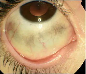 Image of an eye with grey or brown patches