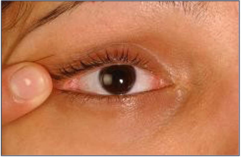 Photo showing method 2 of contact lens removal