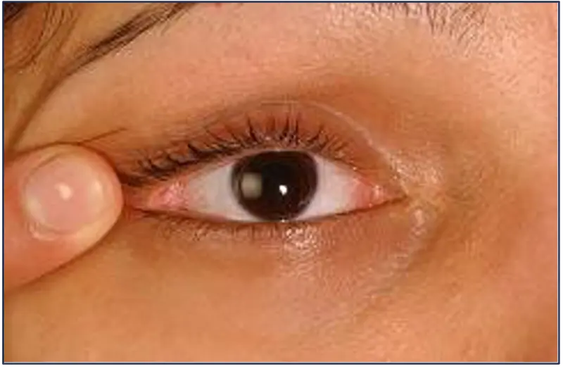 Finger pulling an eyelid to the side 