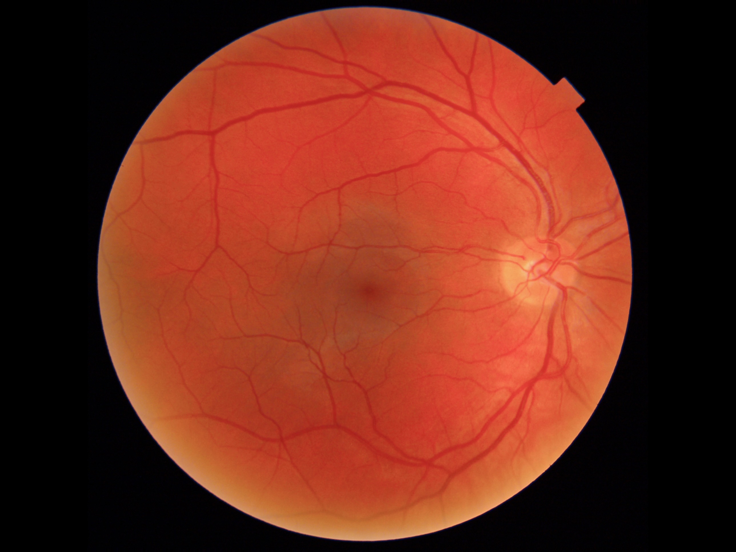 Photo of a Cascader Retinal Image