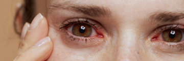 A close up photo of a young woman's face with tired or inflamed eyes