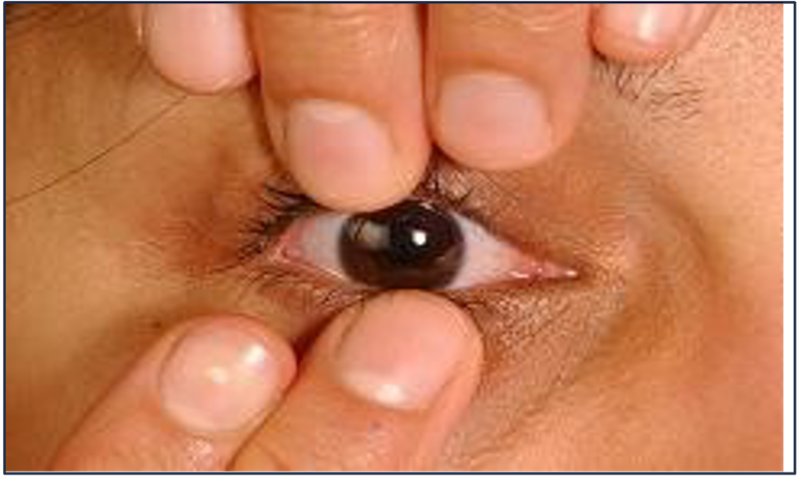 Photo showing method 1 of contact lens removal