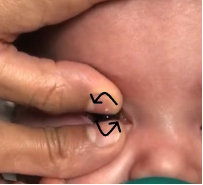 Removing a contact lens from a baby's eye